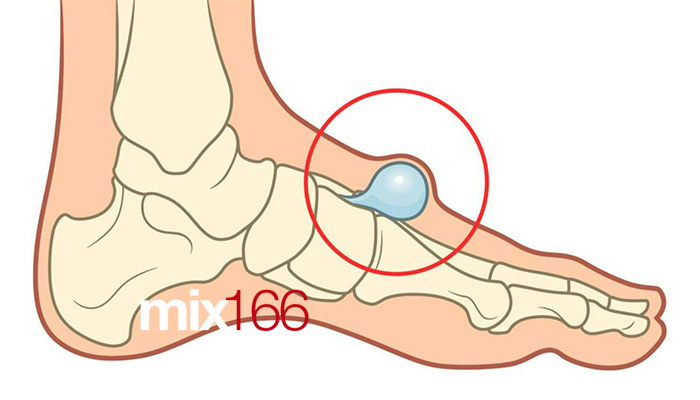 cách chữa rộp chân khi đá bóng